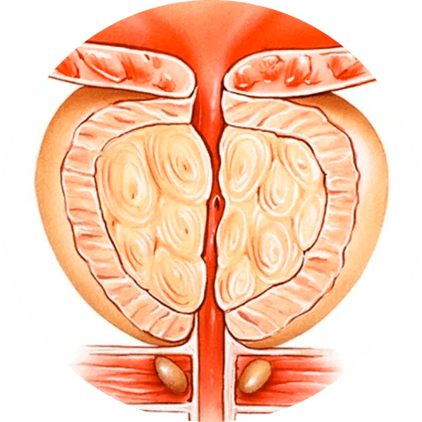 Consequences of untreated prostatitis