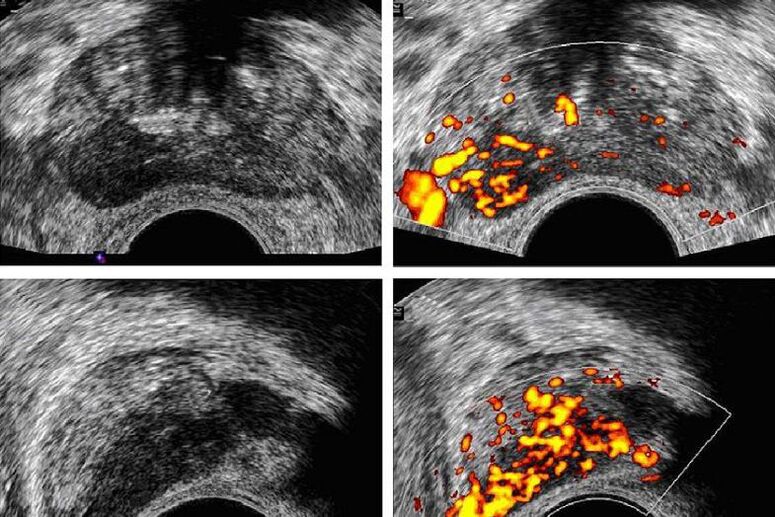 prostate cancer diagnosis